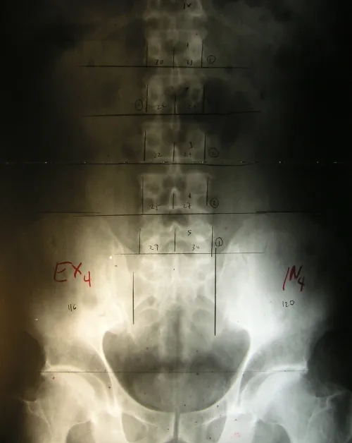 An X-ray image of a pelvis and spine. Various lines, numbers, and labels are marked on the image by hand.